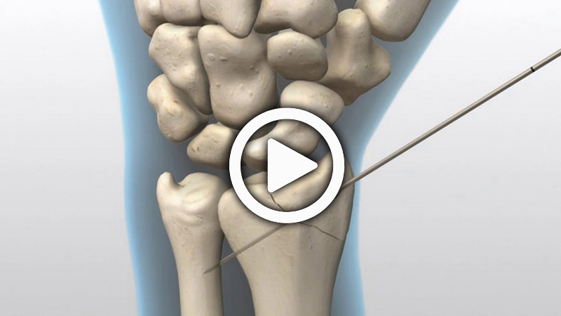 Animated Surgical Technique – Radial Styloid | Acumed