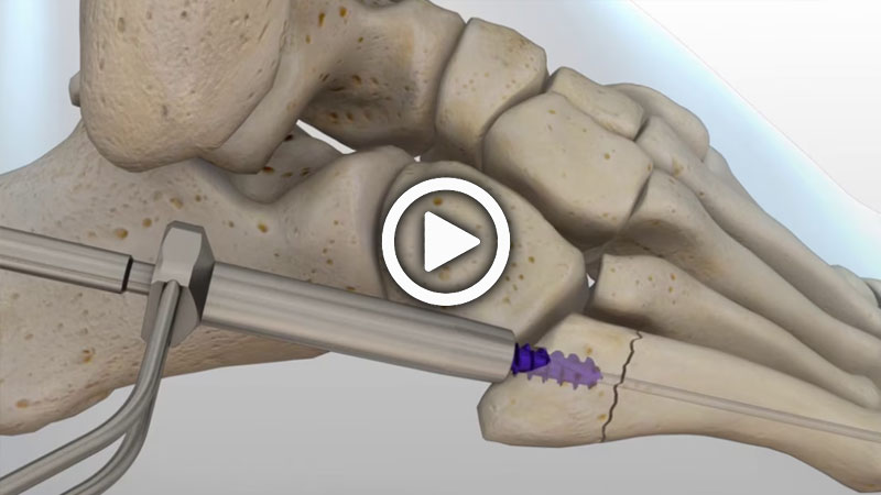 Animated Surgical Technique: Jones Fracture | Acumed
