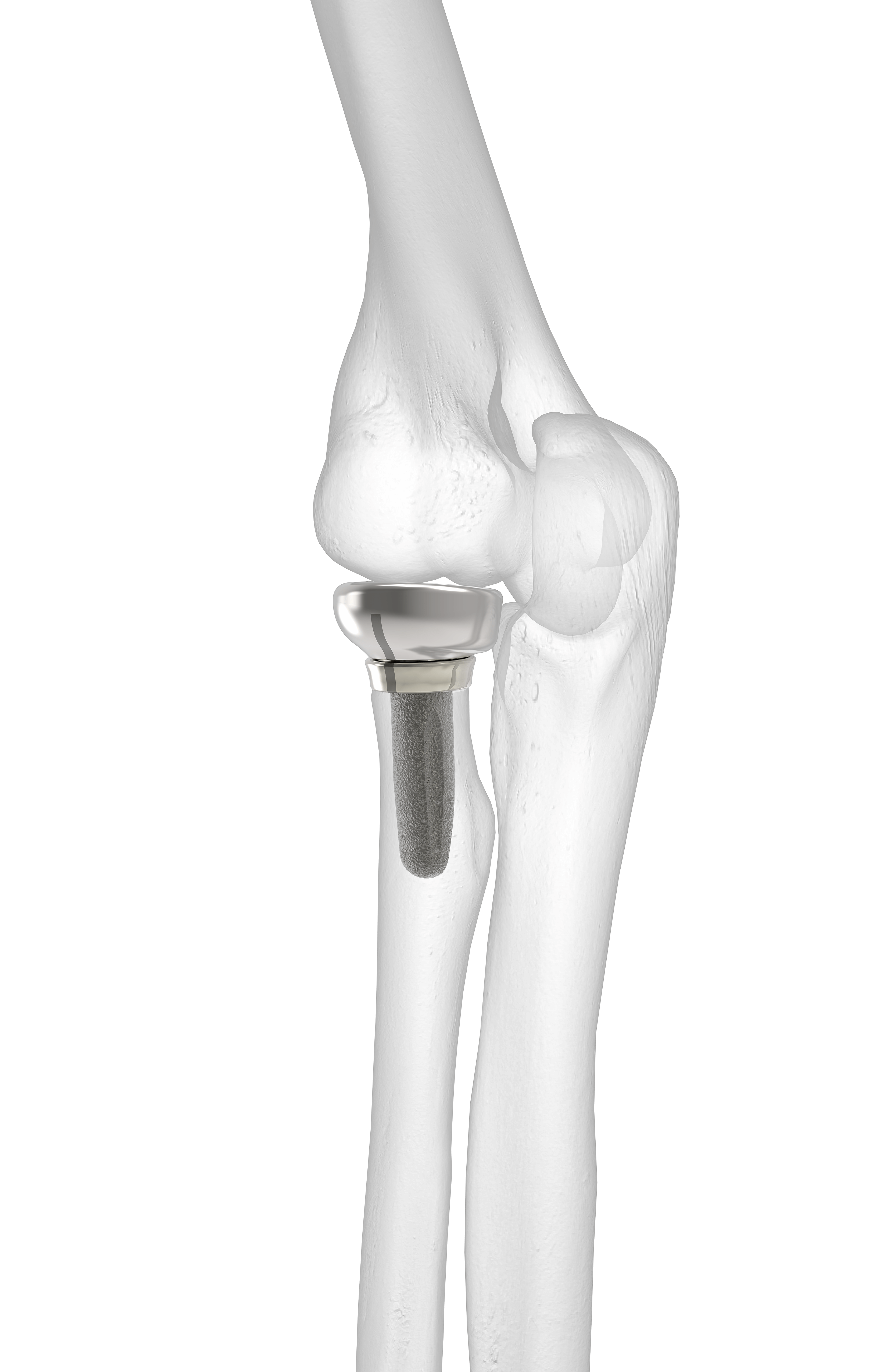 Anatomic Radial Head Acumed