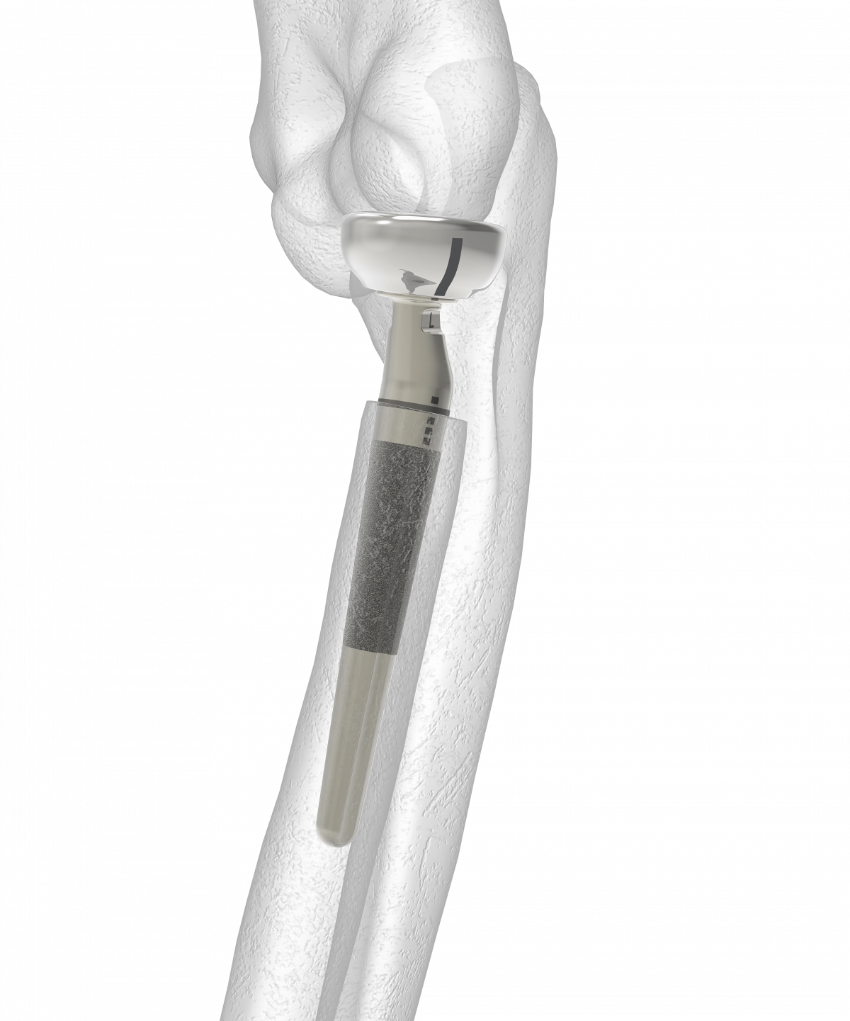 Anatomic Radial Head System Acumed