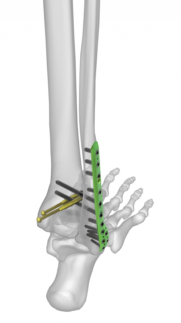 Ankle Plating System 3 Acumed