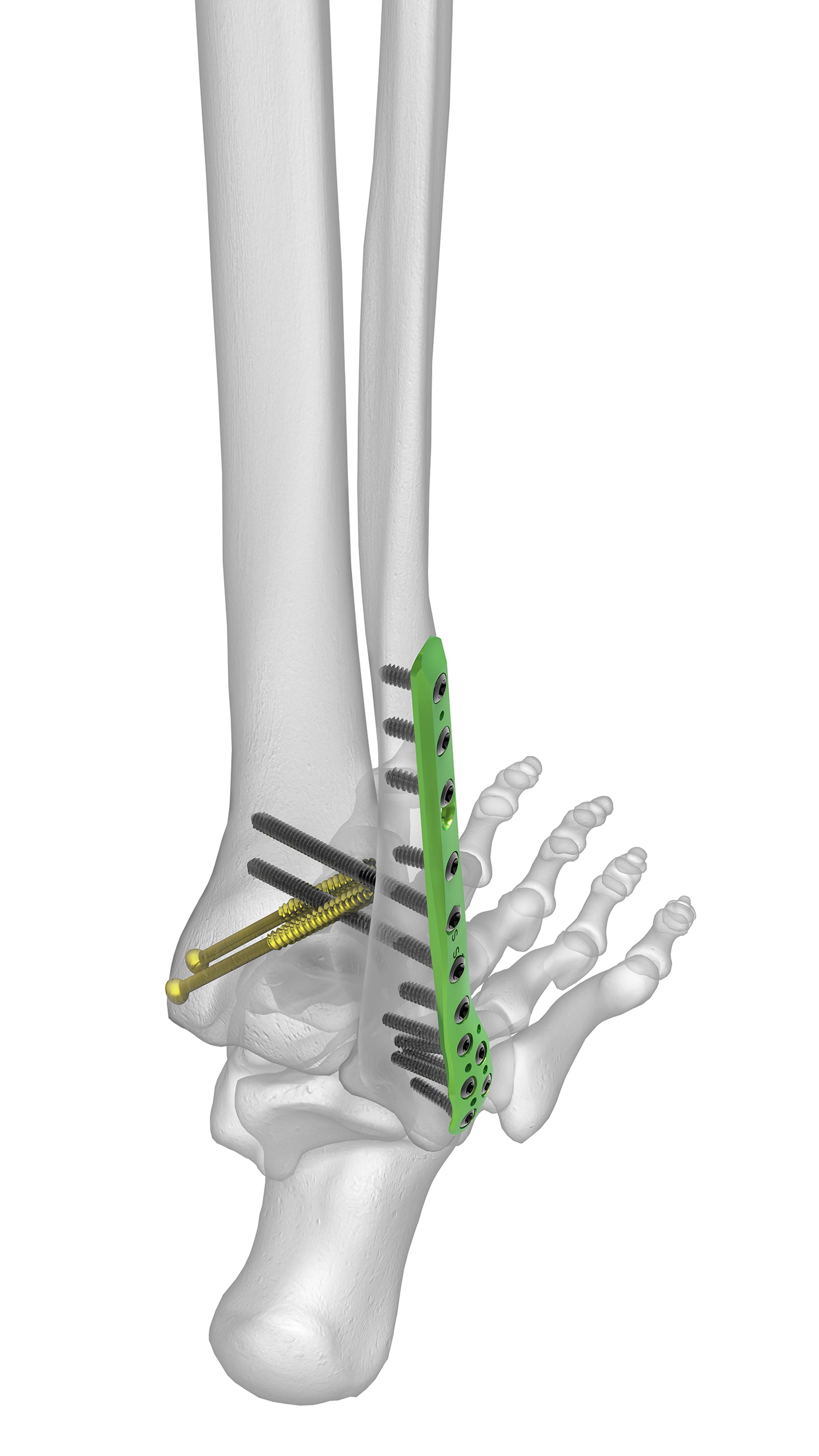 Ankle Plating System 3 | Acumed