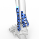 Ankle Plating System 3 | Acumed