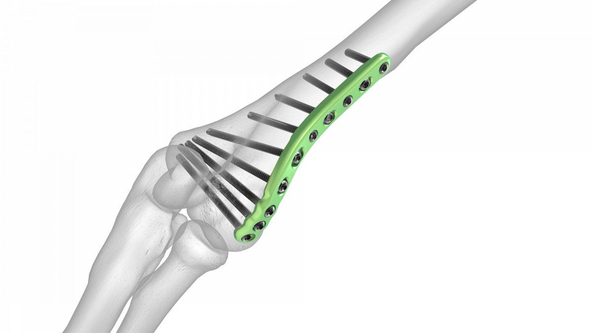 Lateral Column Plate Acumed