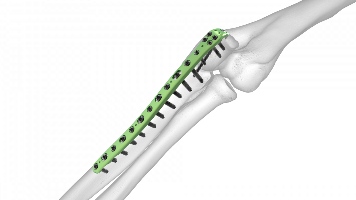 Olecranon Plate Acumed