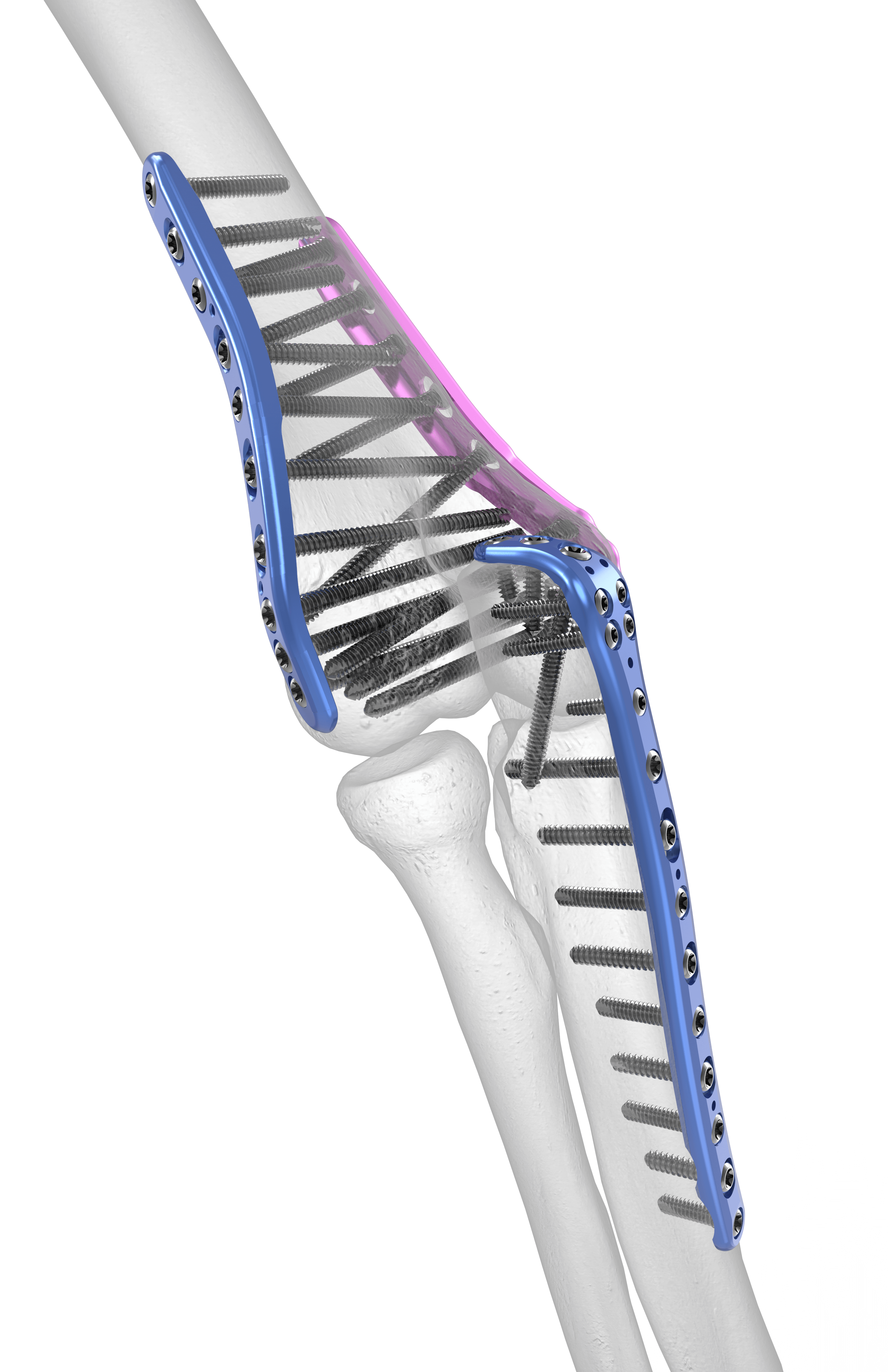 Elbow Plating System Plates Acumed