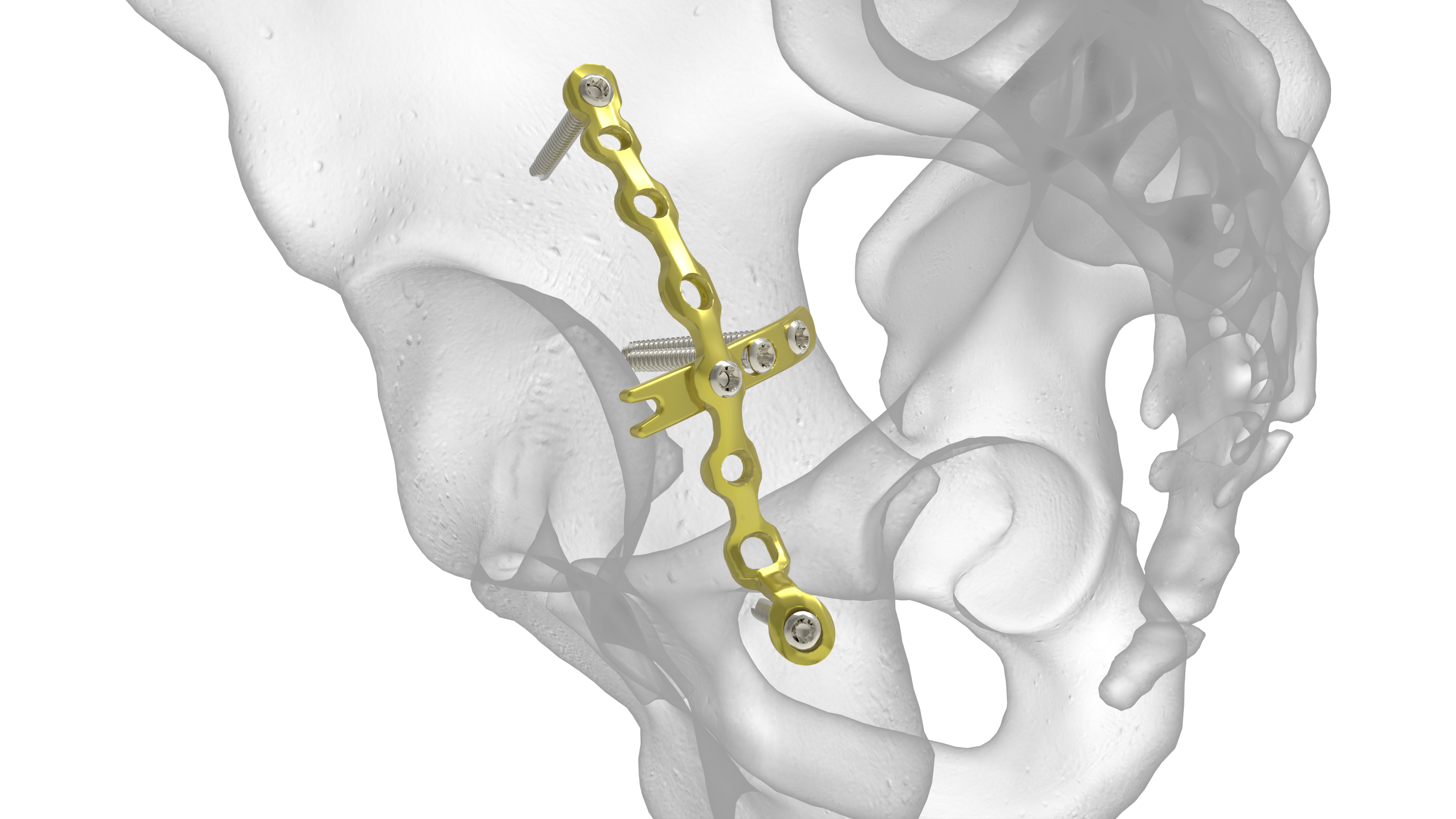 Pelvic Plating System | Acumed