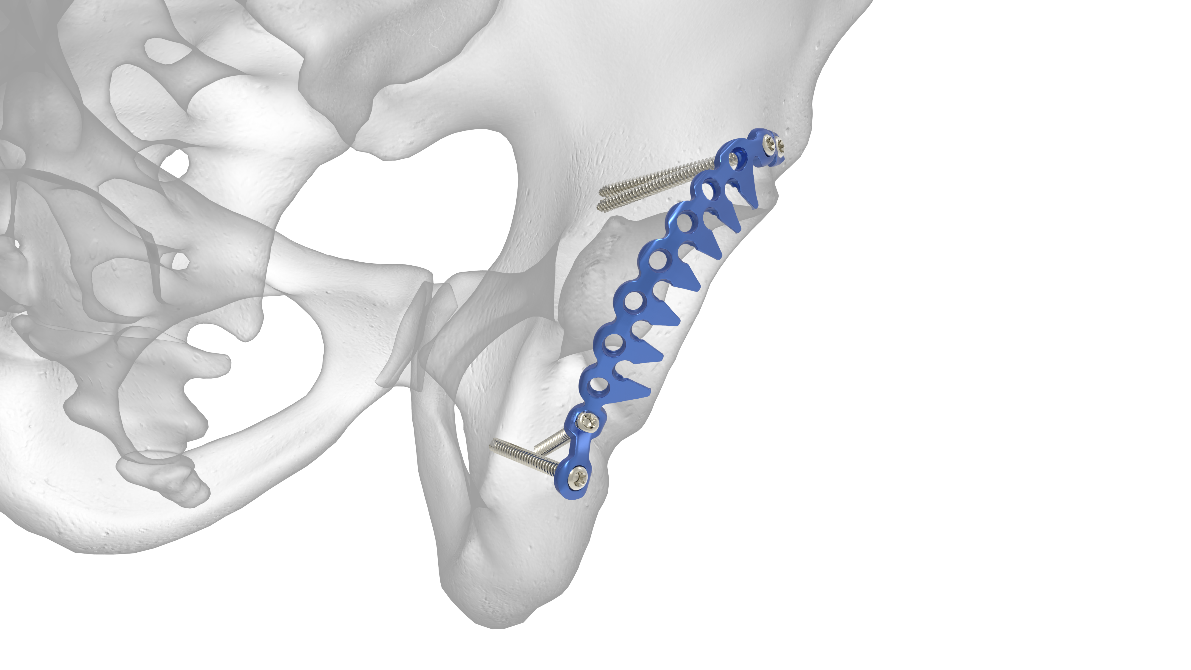 Pelvic Plating System | Acumed