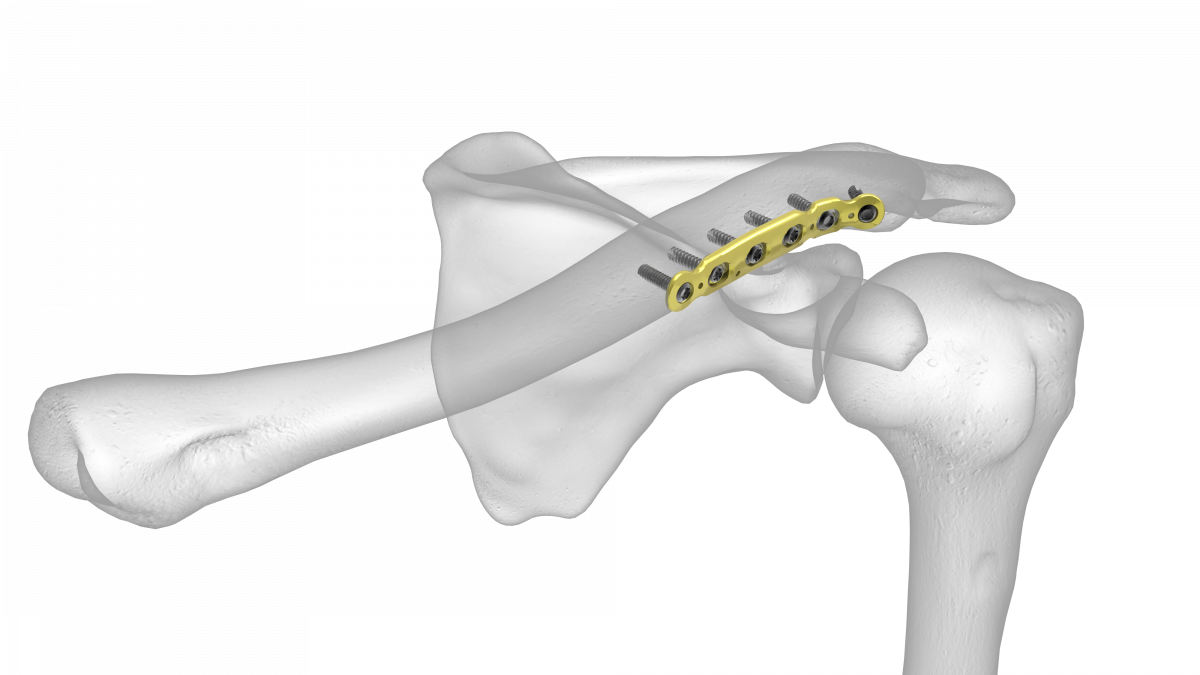 Anterior Clavicle Plate Acumed