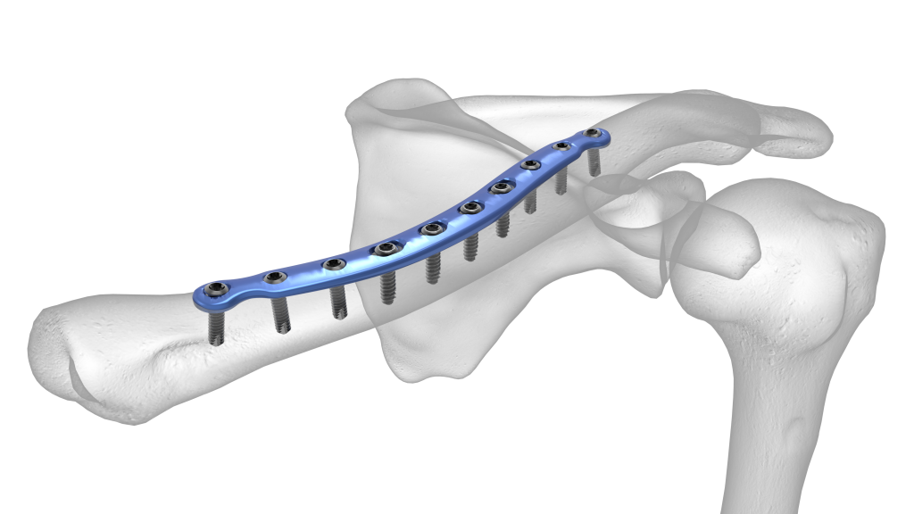 Clavicle Plating System Acumed