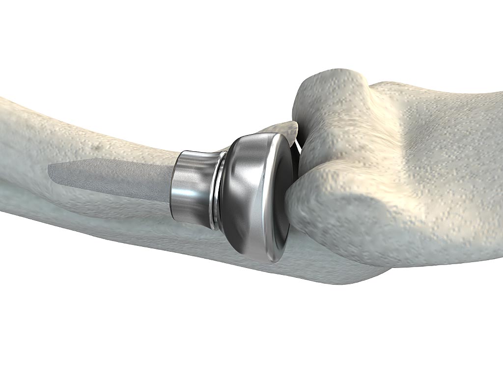 Anatomic Radial Head System Acumed