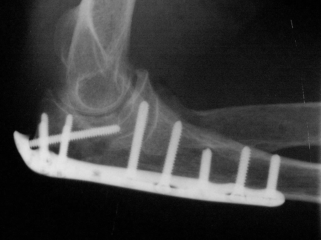 Elbow Plating System Acumed