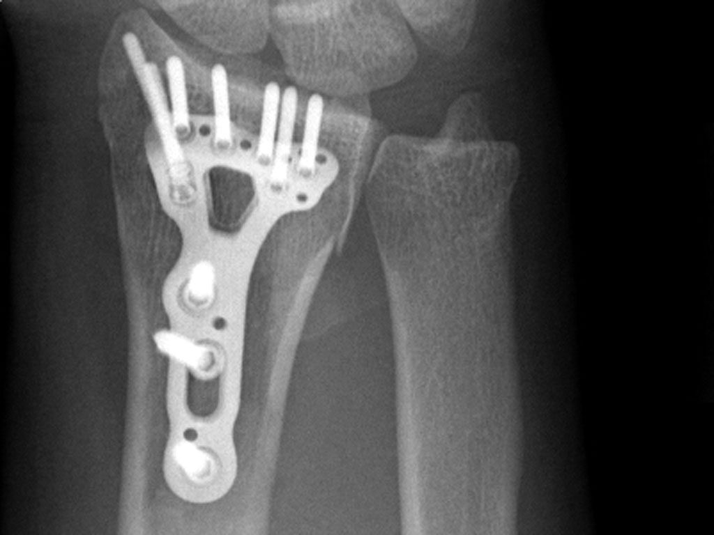 Acu-Loc 2 Wrist Plating System | Acumed