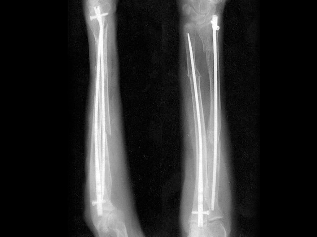 Figure 10 from Infected Nonunion of Radius and Ulna – Strategy of Approach  | Semantic Scholar