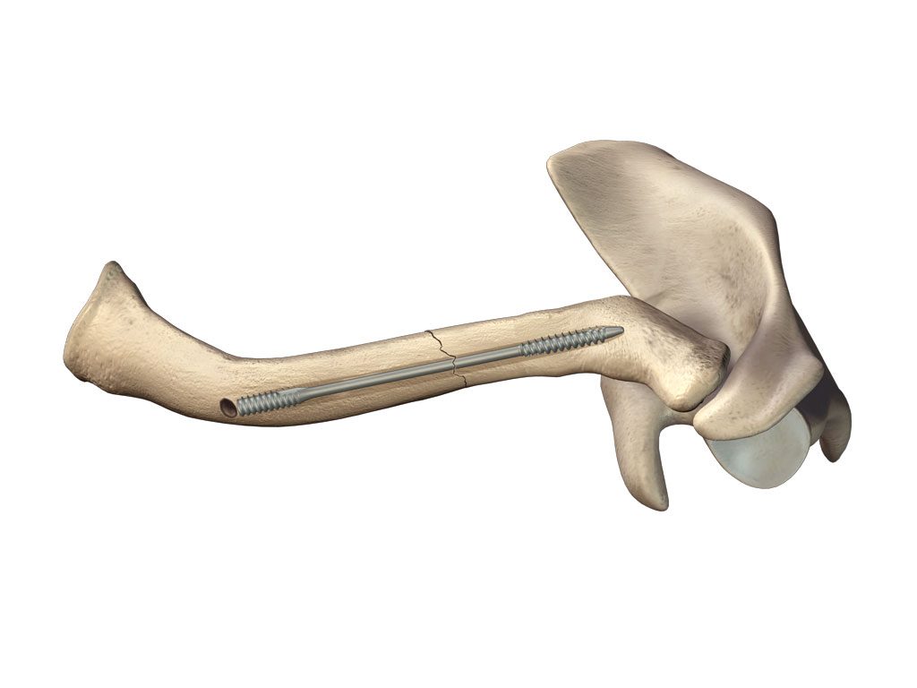 Dual-Trak Clavicle Screw System | Acumed