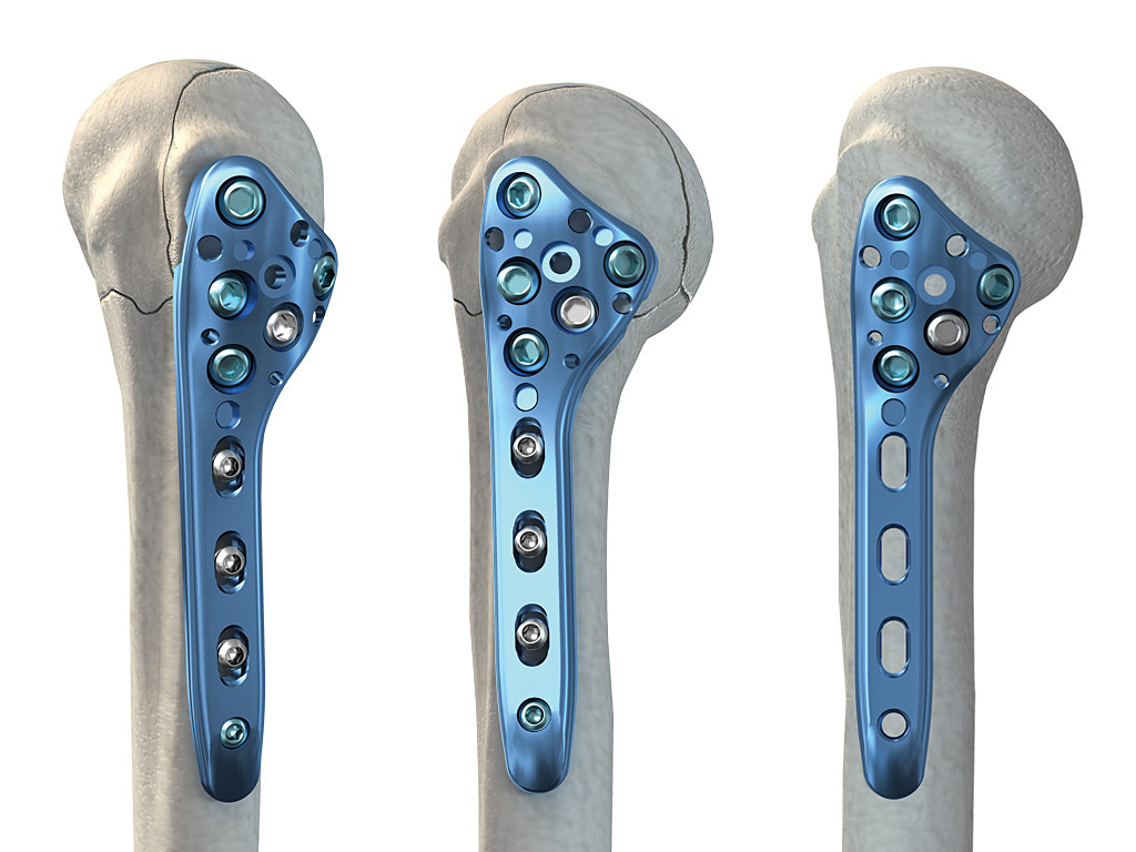 Synthes Proximal Humerus Plate