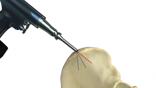 Bone Graft Harvesting System