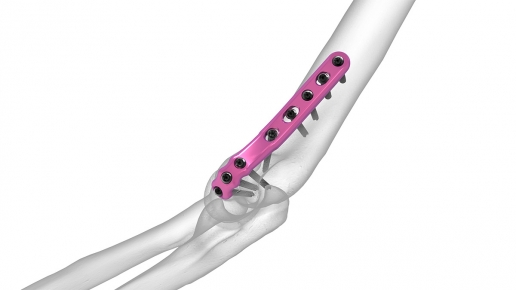 Medial Column Plates