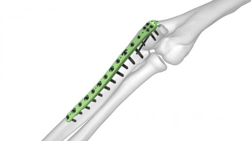 Olecranon Plates