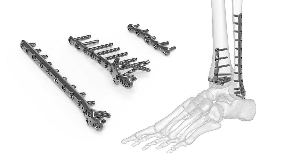 Distal Tibia Plate Surgical Technique