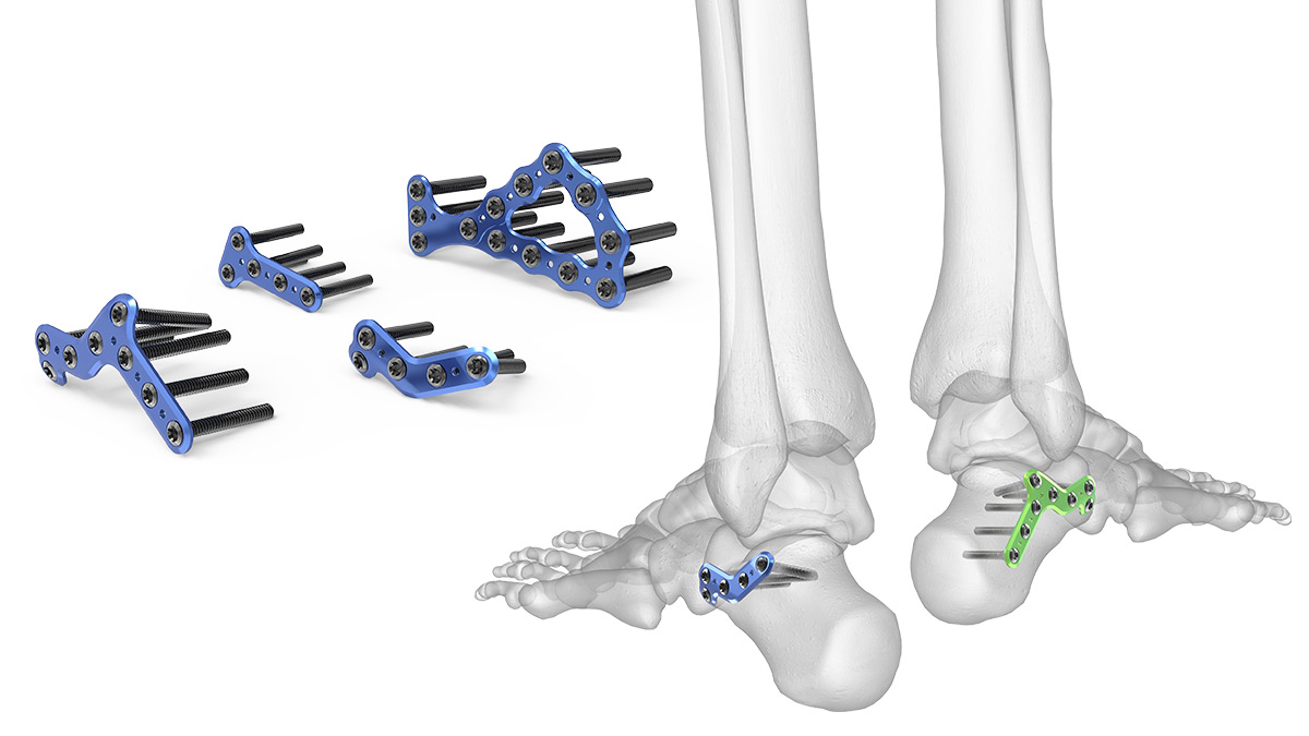 Calcaneal Plating System | Acumed