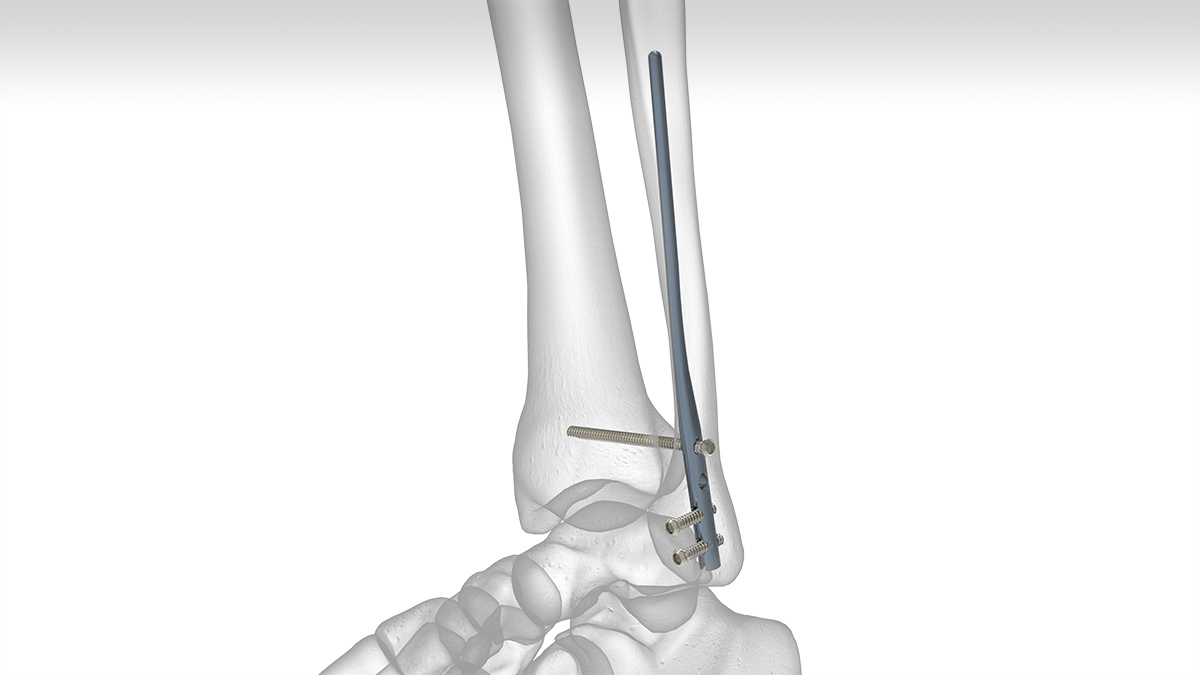 Fibula Rod System Acumed