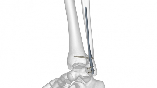 Fibula Rod System