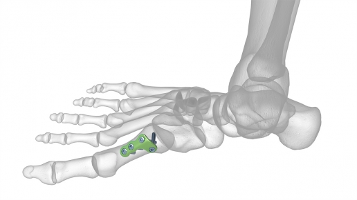 Osteotomy Plates 