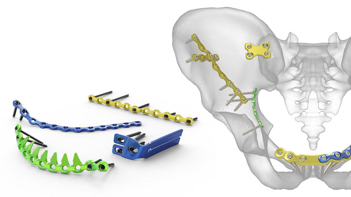 PDF) Mandibular tori as a source for onlay bone graft augmentation: a  surgical procedure