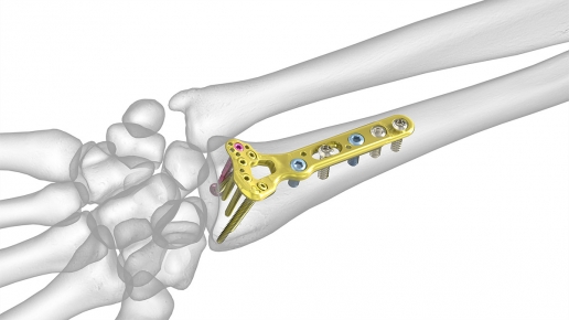 Proximal Volar Distal Radius Plates