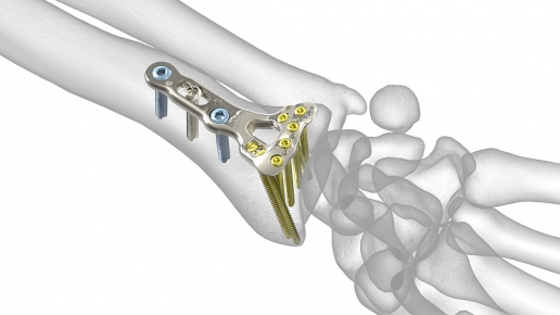 Standard Volar Distal Radius Plates