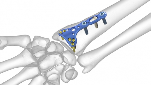 Dorsal Distal Radius Plates