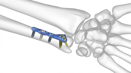 Volar Distal Ulna (VDU) Plates