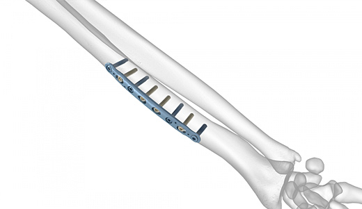 Dorsolateral Midshaft Radius Plates