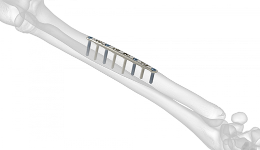 Midshaft Ulna Plates