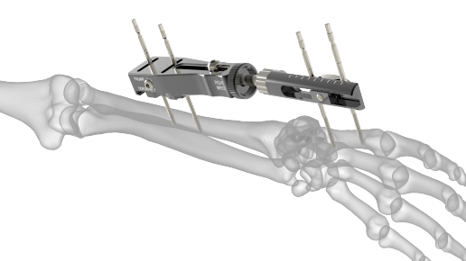 Stableloc External Fixation System