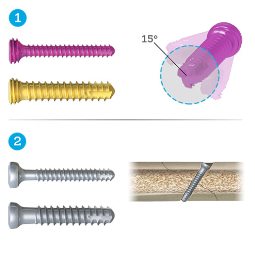 Proximal Volar Distal Radius Plates