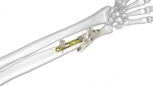 Osteotomy System