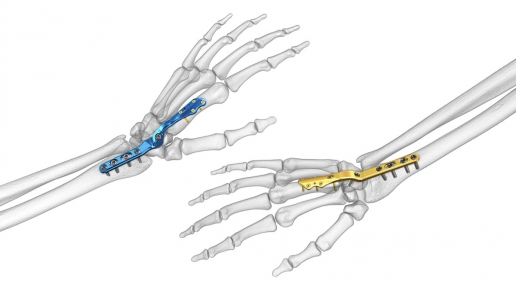 Total Wrist Fusion Plating System