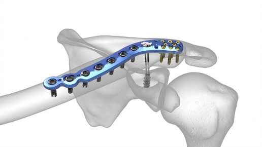 The Acumed Distal Clavicle Plate is designed to provide fracture fixation and stability for lateral third clavicle fractures, malunions, and nonunions, and where there is disruption to coracoclavicular (CC) ligaments. Multiple distal screw configurations are designed to achieve construct stability, while screw positioning targets distal fragments to provide secure, stable fixation for multiple fracture patterns.