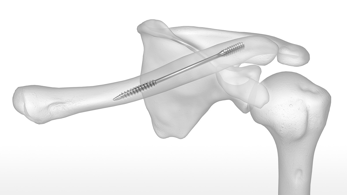 Dual-Trak Clavicle Screw System | Acumed