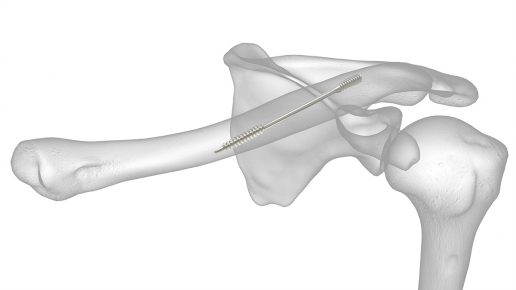 Dual-Trak Clavicle Screw System