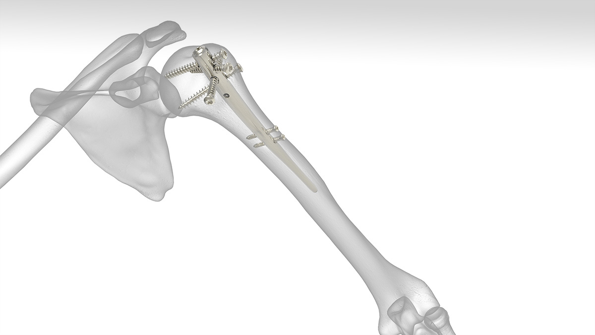 Evolution of Intramedullary Nails for Long Bone Fractures in the Upper Limb  | SpringerLink
