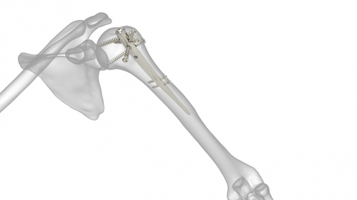 Polarus Humeral Rod System