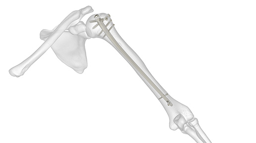 Polarus Humeral Rod System