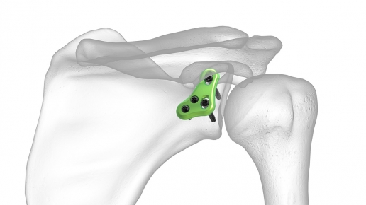 Glenoid Plate