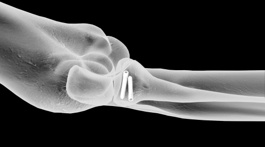 Standard Volar Distal Radius Plates