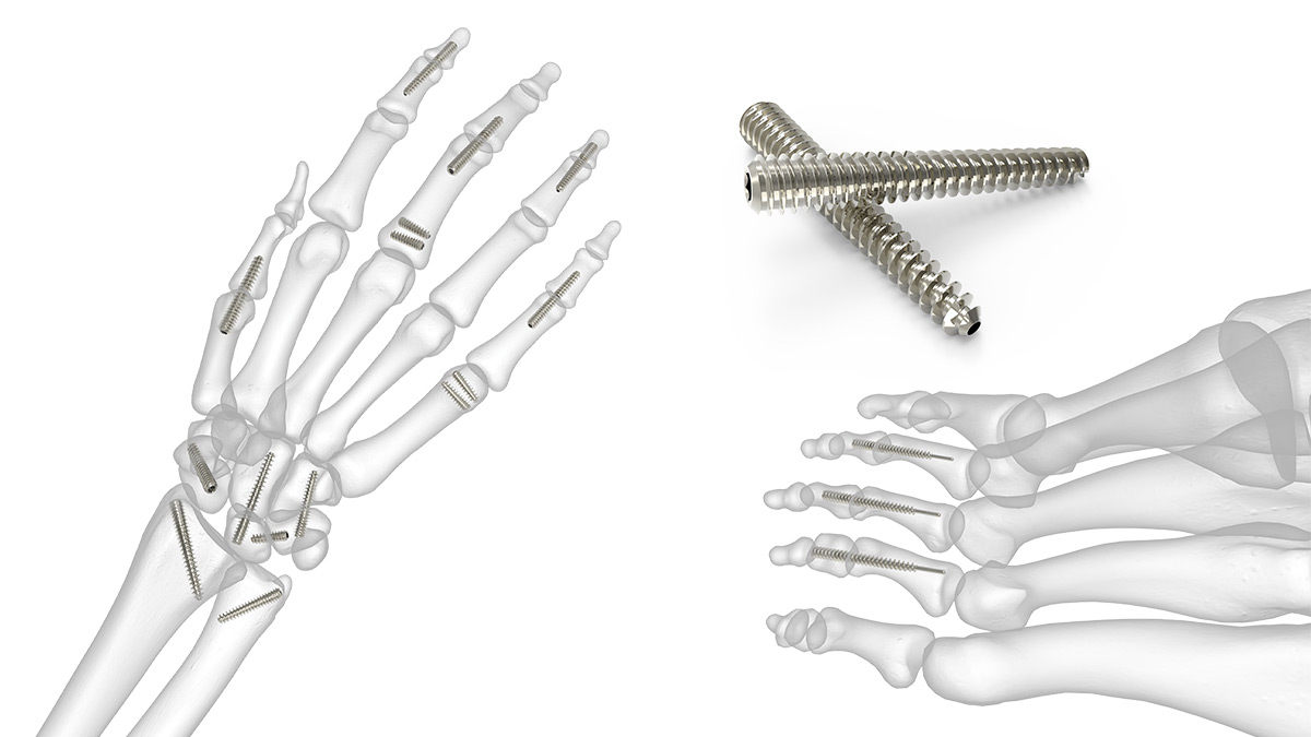 Bone screw. DEPUY Synthes винты. Кейдж шейный DEPUY Synthes Bengal. Эндопротез лучезапястного сустава. Титановые вставки в кисть.