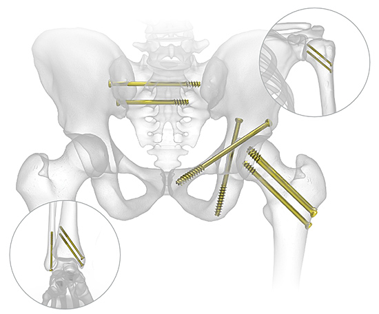 6.5 mm and 7.3 mm Cannulated Screws