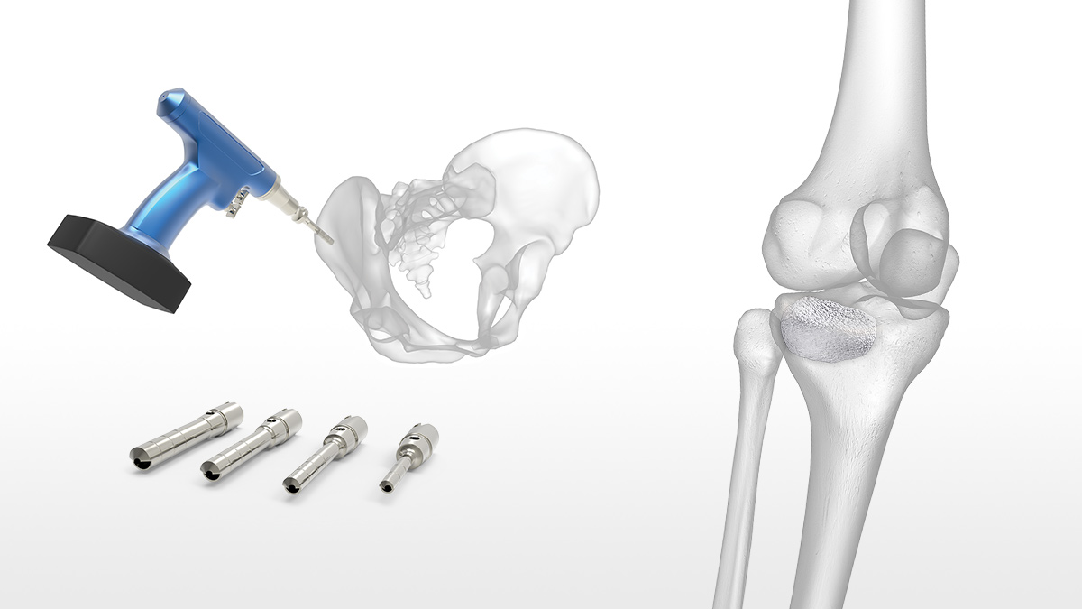 Accumedex Polyester Pelvic Sacral Wedges, For Clinical, Model Name